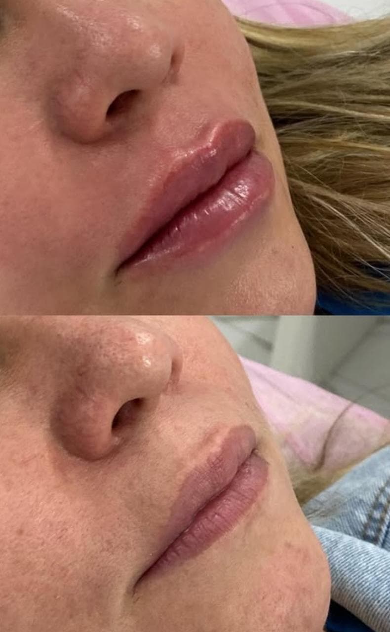 Preenchimento Labial