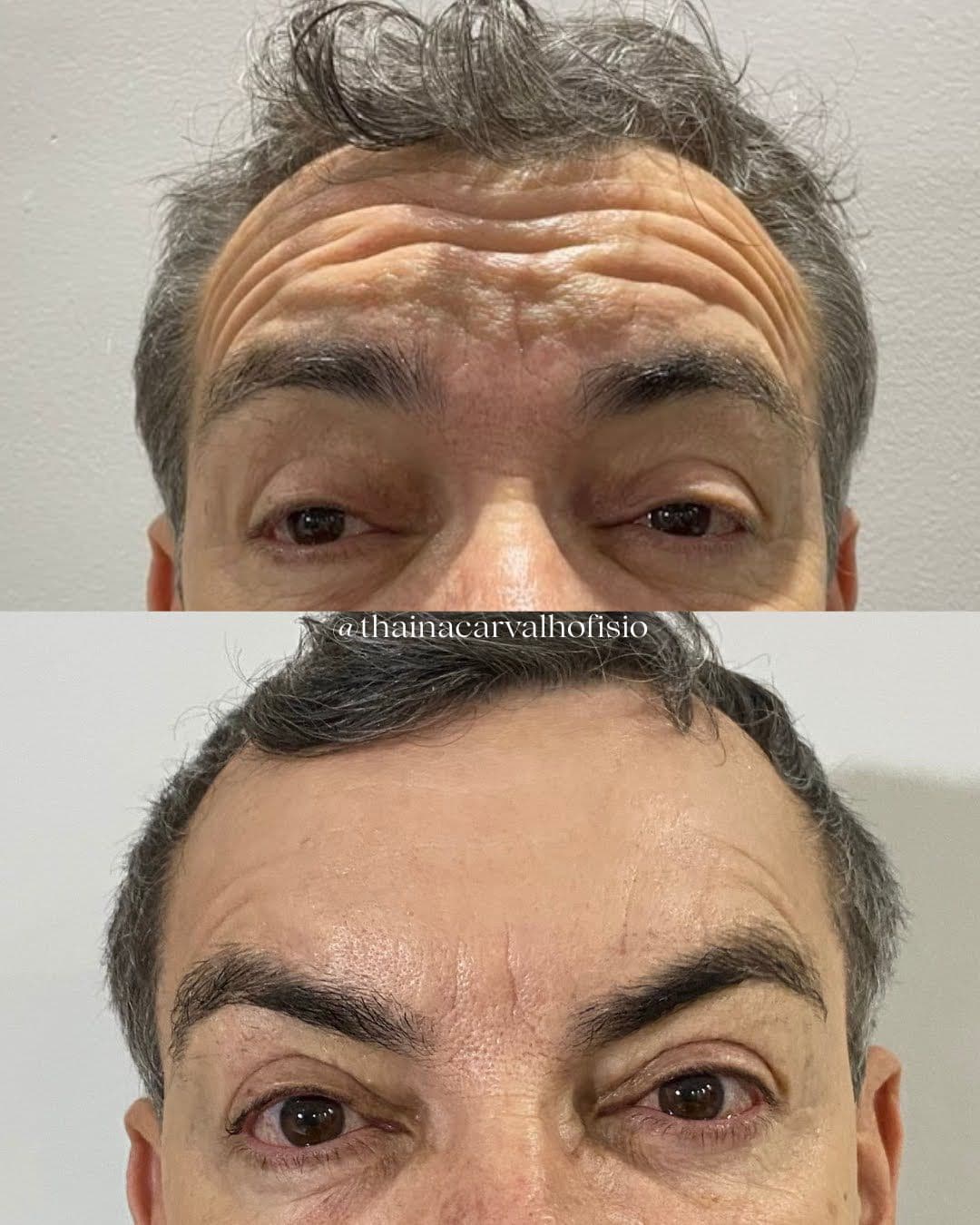 Botox Global