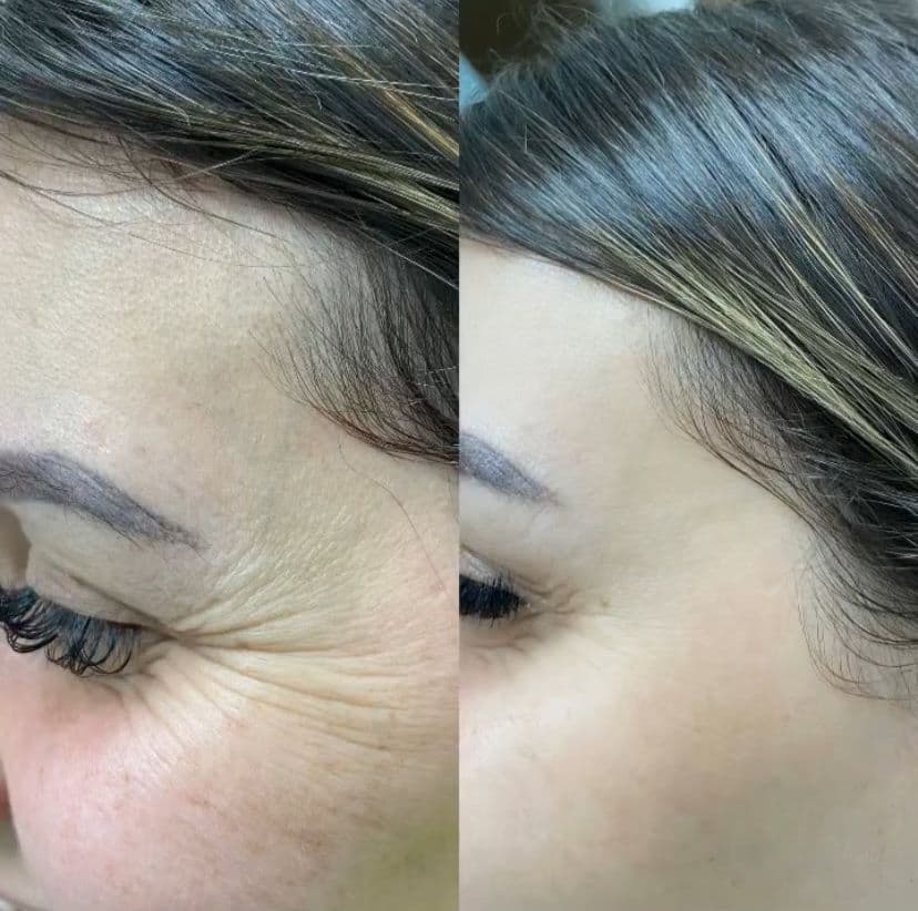 Rejuvenescimento Facial