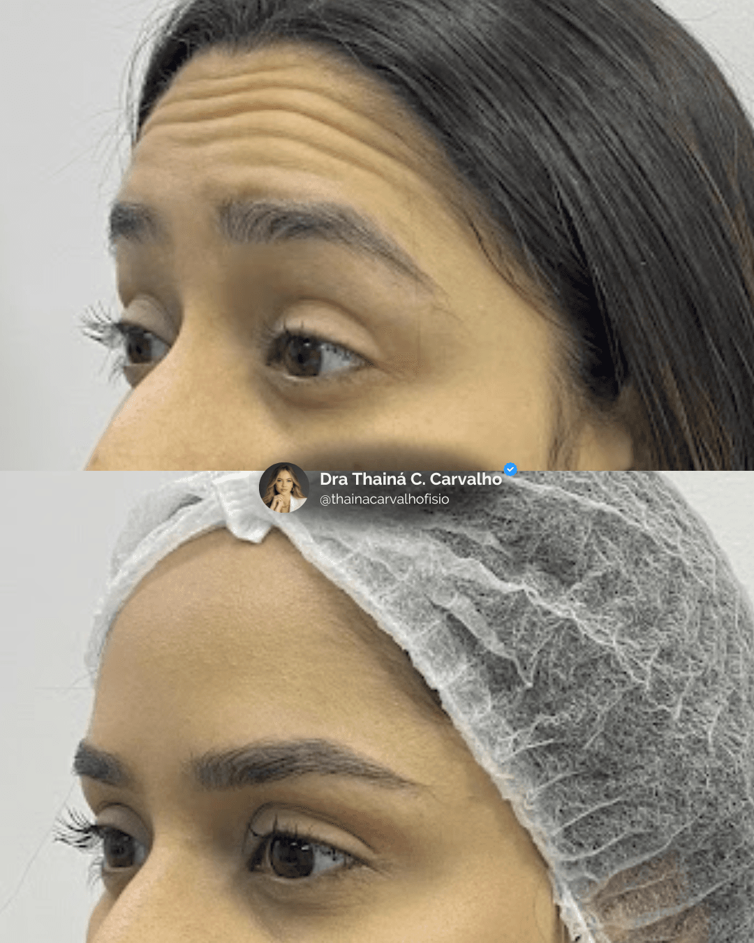 Toxina Botulínica