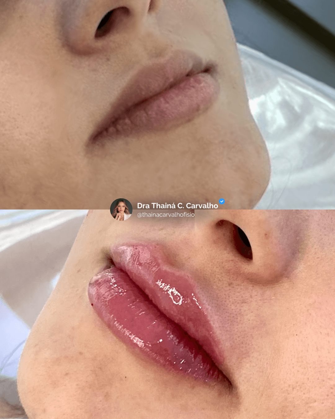 Preenchimento labial