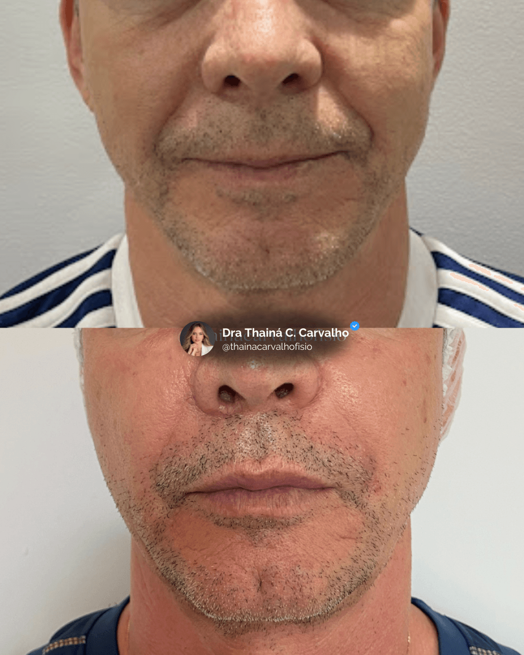 Preenchimento de Bigode Chinês (Sulco Nasogeniano)